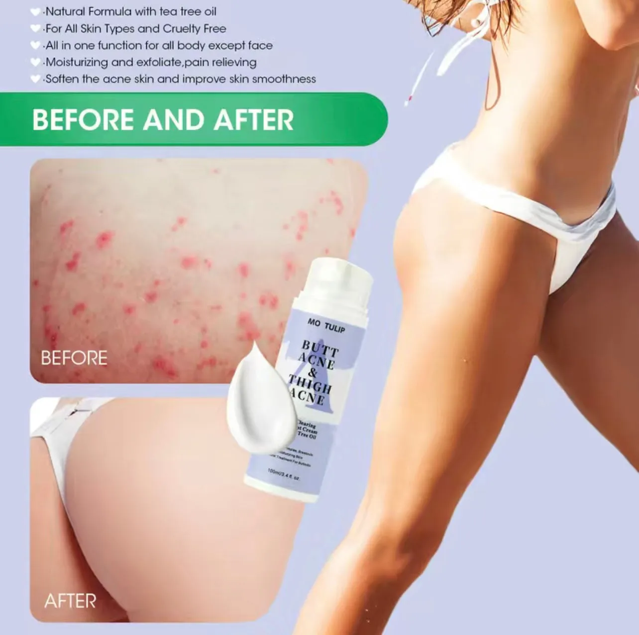 Clinical Strength Antibacterial Buttocks Acne Healing- Scar Removal Treatment Cream
