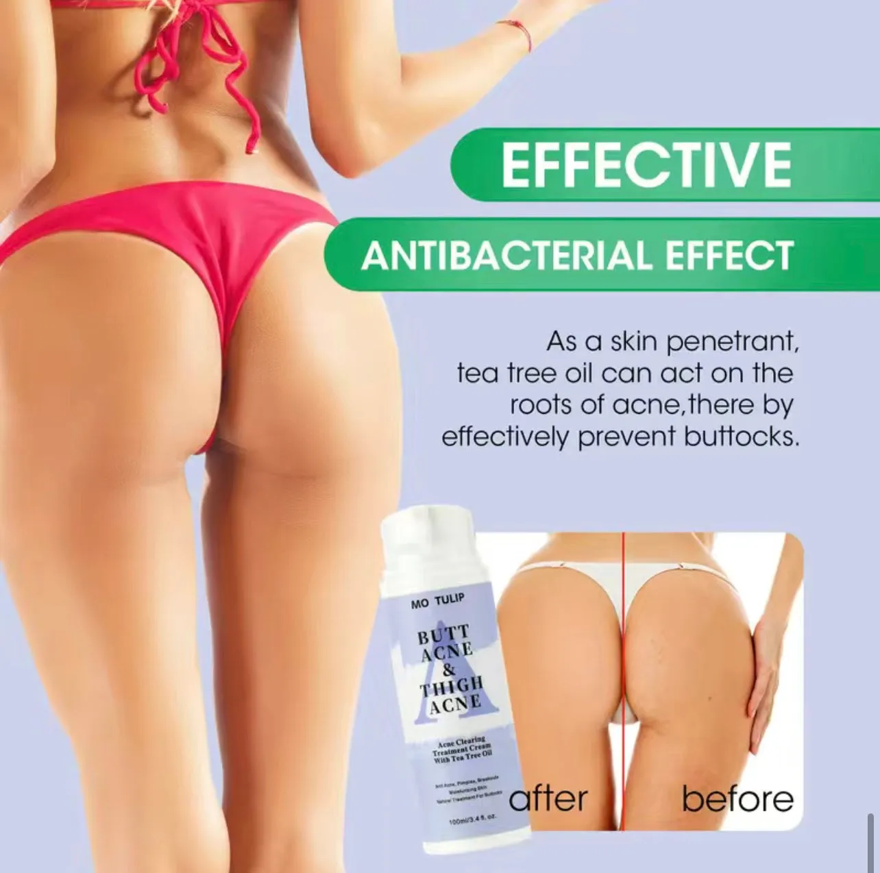 Clinical Strength Antibacterial Buttocks Acne Healing- Scar Removal Treatment Cream