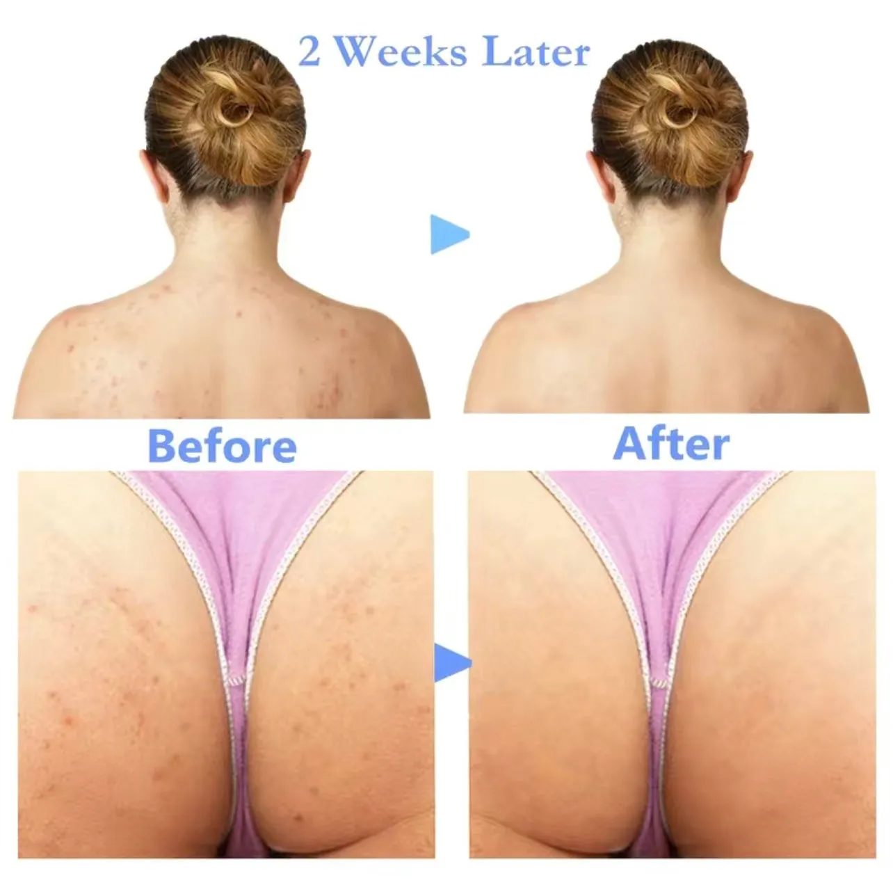 Clinical Strength Antibacterial Buttocks Acne Healing- Scar Removal Treatment Cream